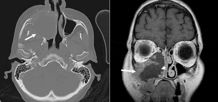 U ác khoang mũi có thể chẩn đoán khi chụp MRO hoặc CT